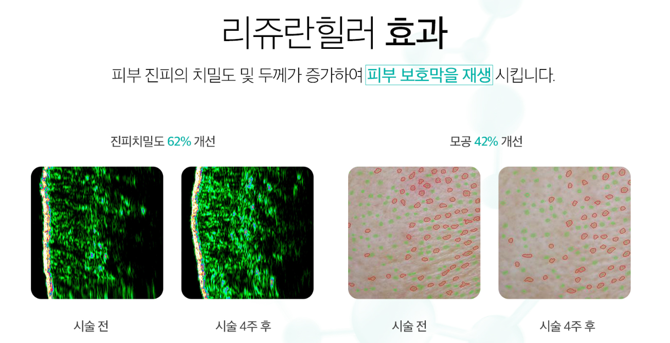 리쥬란힐러 효과 4f313f307dc2