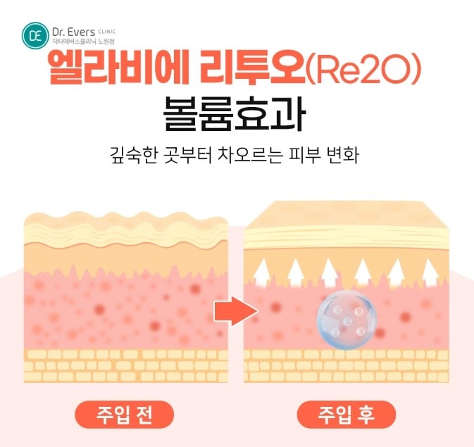 엘라비에 리투오 눈밑 1실린지 시술 주기 부작용_노원피부과 닥터에버스의원 노원점