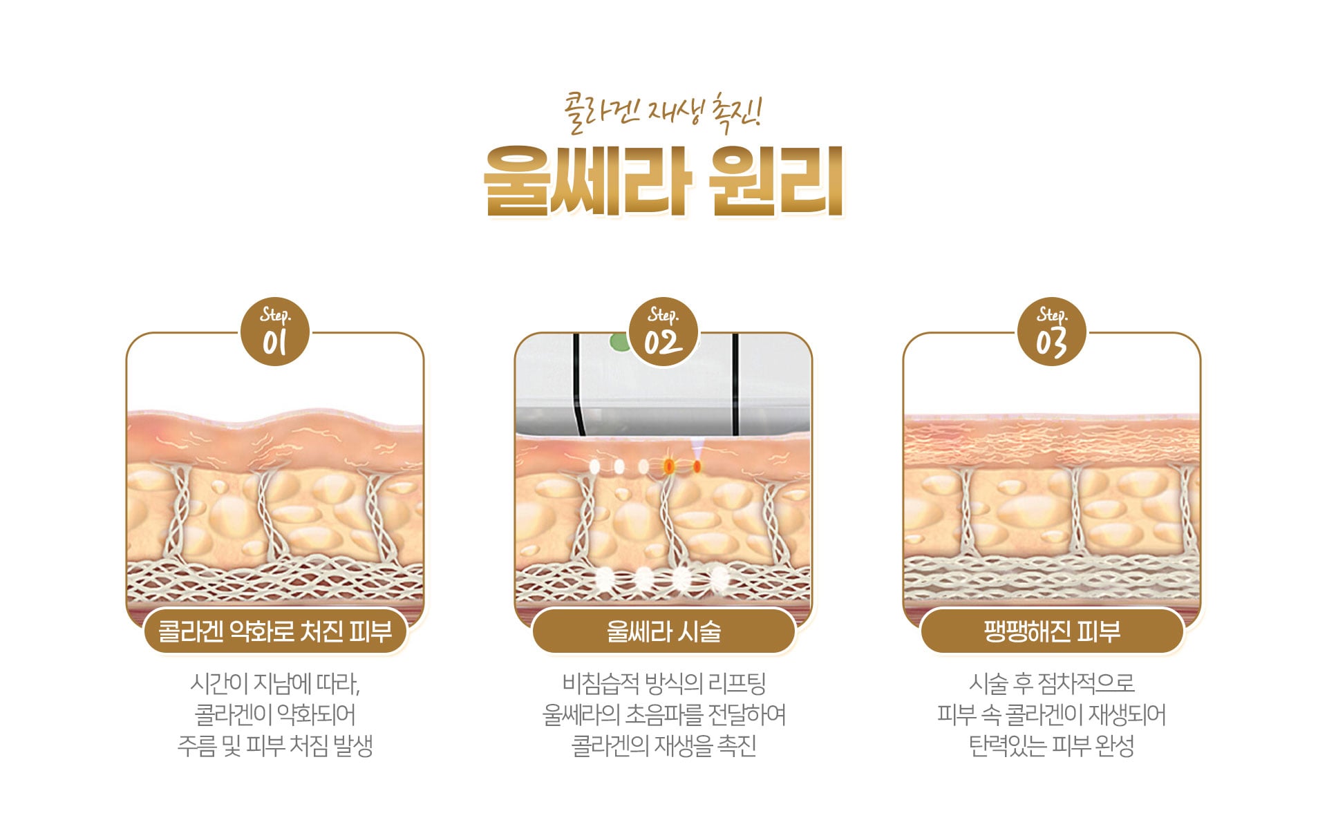 콜라겐 재생 촉진 울쎄라 원리 a5dbcdc13787