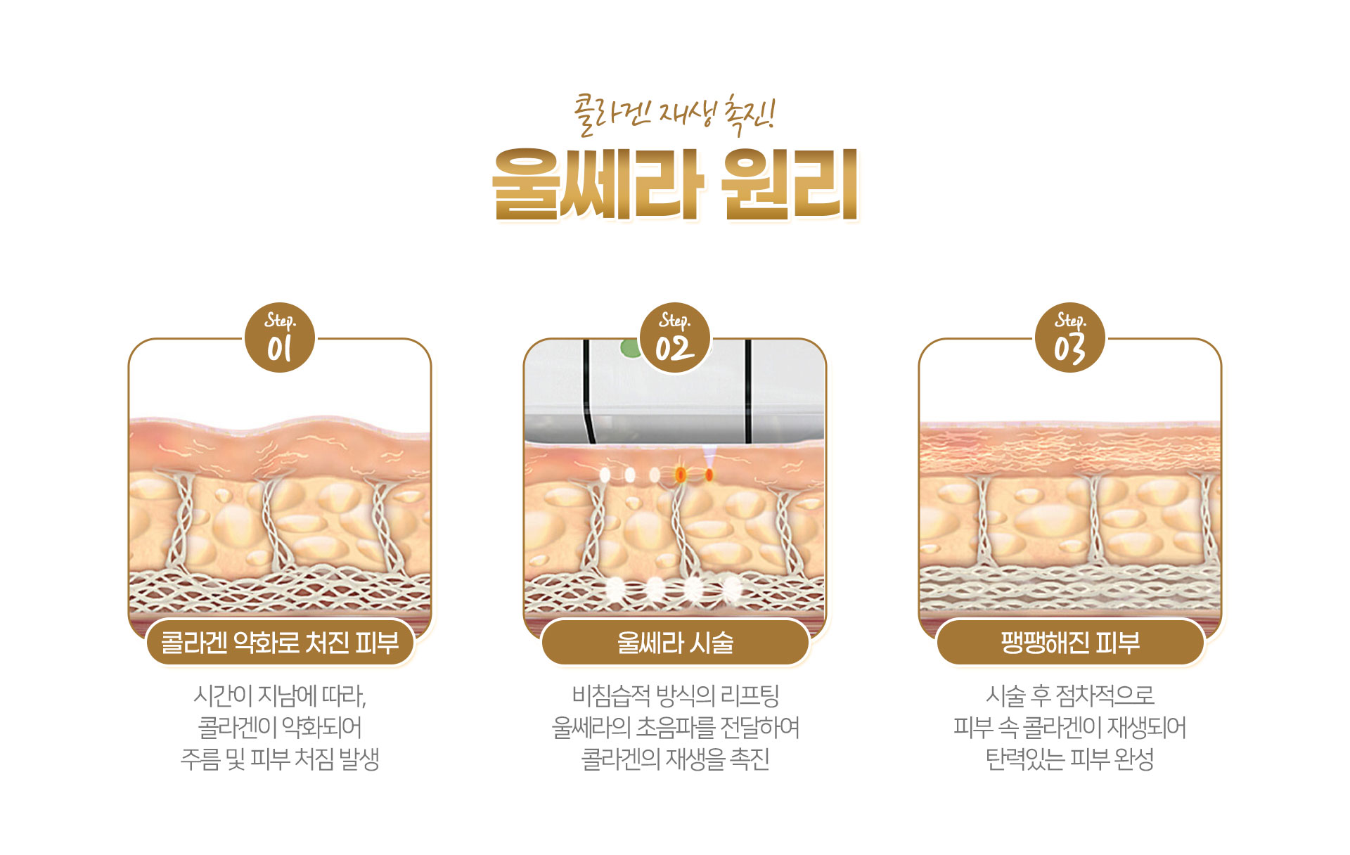 울쎄라 원리 노원피부과 닥터에버스 d78adb420eba